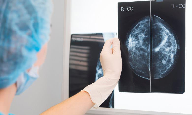 في سابقة عالمية..العلاج المناعي يشفي مصابة بسرطان الثدي