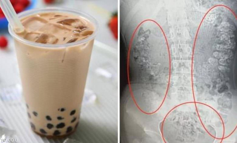 صدمة للأطباء.. 100 كرة شاي في أحشاء مراهقة صينية