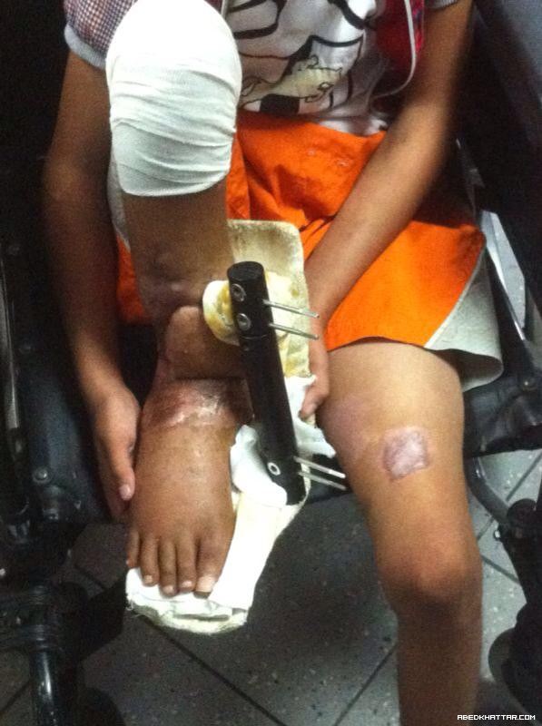 قصة الطفل مصطفى شتيوي ... وجع وألم وانتظار لأصحاب الضمائر الحية