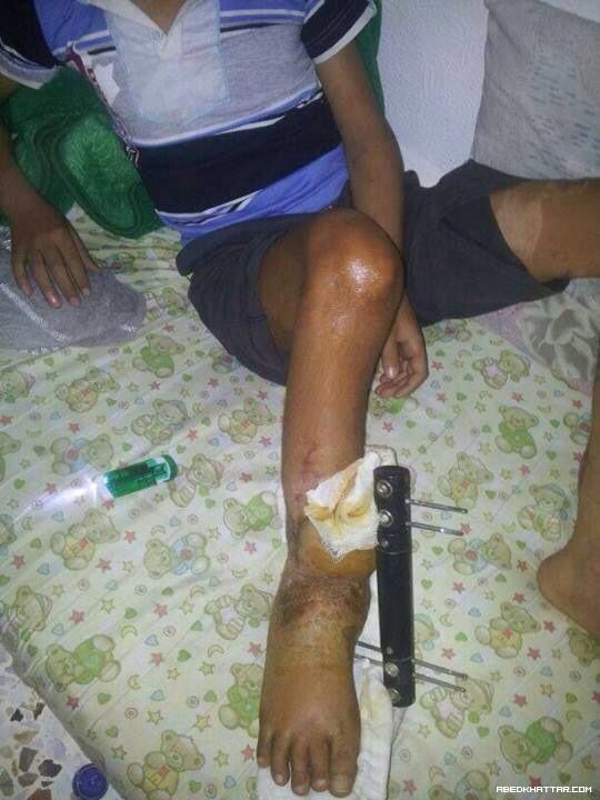 قصة الطفل مصطفى شتيوي ... وجع وألم وانتظار لأصحاب الضمائر الحية